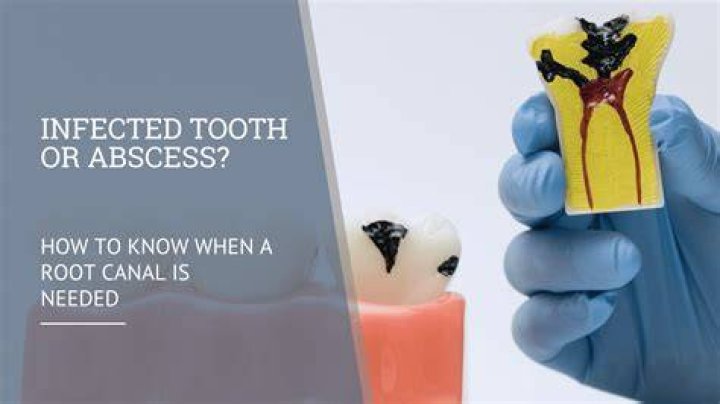 Can a root canal stop an abscess?