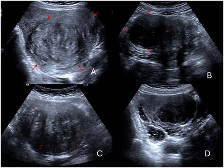 Can fibroids damage ovaries?