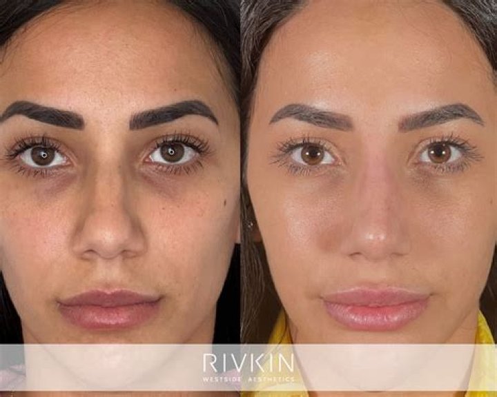 Can fillers help a bulbous nose?