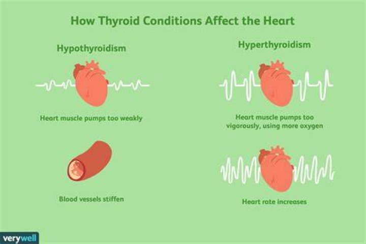 Can hypothyroidism affect your heart?