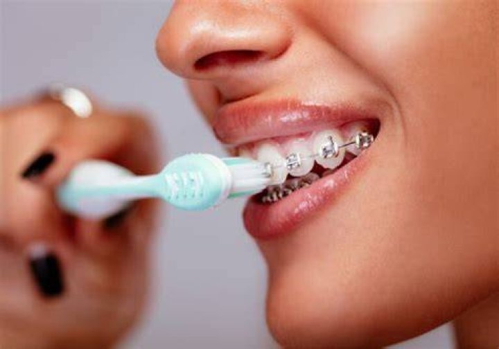 Can I brush my teeth once a day with braces?
