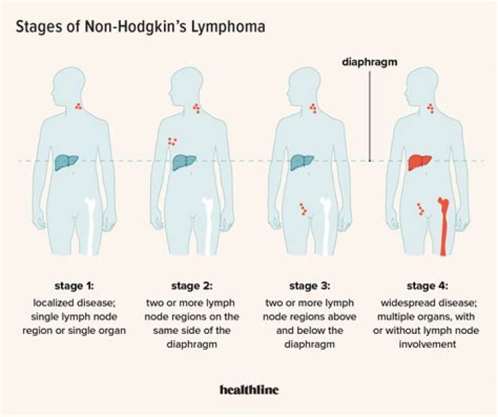 Can non-Hodgkin's lymphoma affect the eyes?