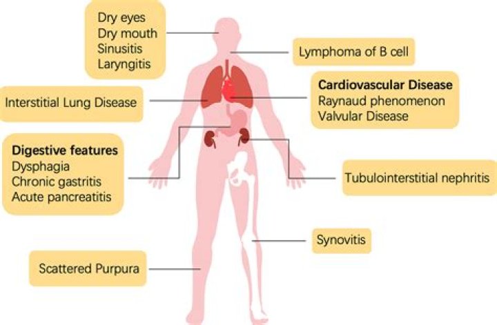 Can Sjogren's affect the heart?
