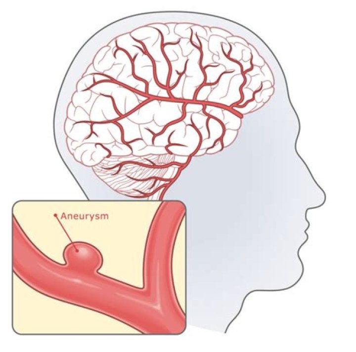 Can straining to poop cause an aneurysm?
