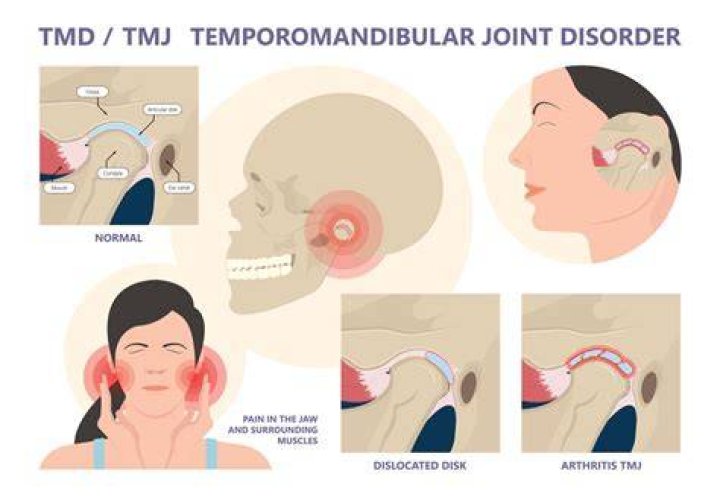 Can TMJ cause high blood pressure?