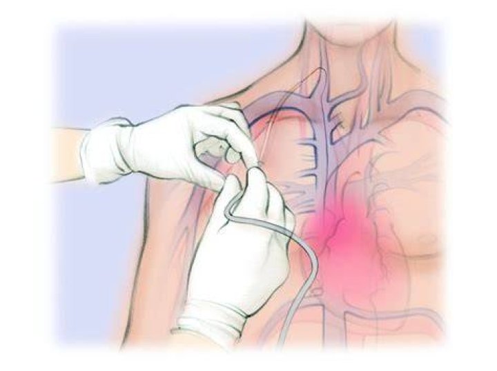 Can Tops for dialysis?