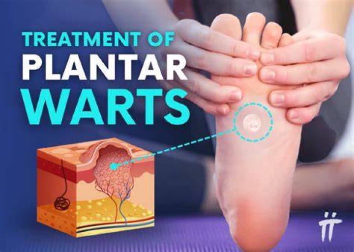 Can you cut a plantar wart out?