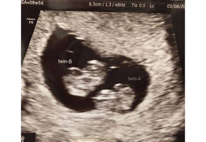 Can you miss a twin at 8 week ultrasound?