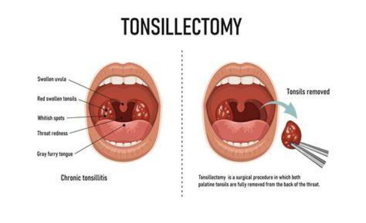 Can you squeeze pus out of tonsils?