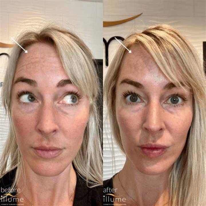 Can you tell you've had Botox straight after?
