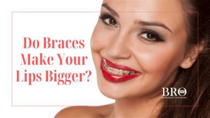 Do braces give you bigger lips?