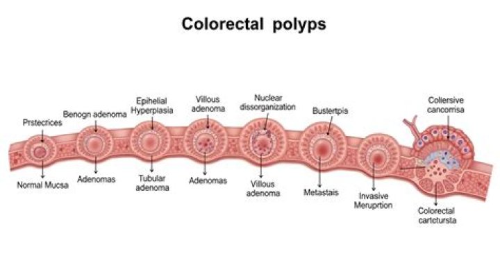 Do polyps turn into cancer if not removed?