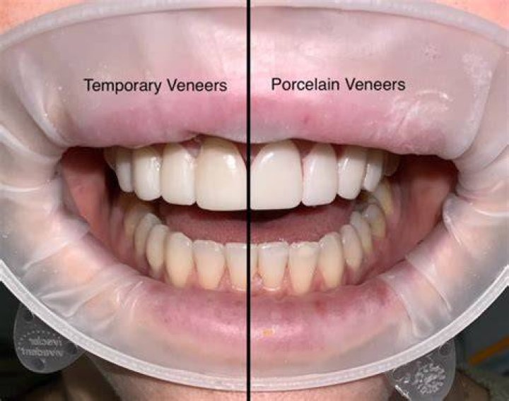 Do temporary veneers look like permanent?