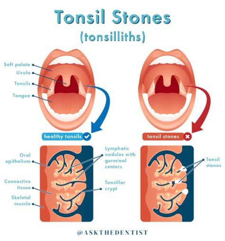 Do tonsil stones mean your sick?
