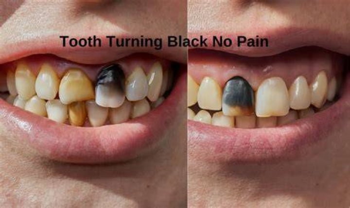 Does a cracked tooth turn black?