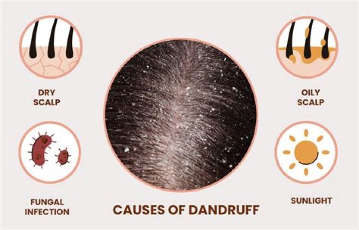 Does dandruff mean your hair is dirty?