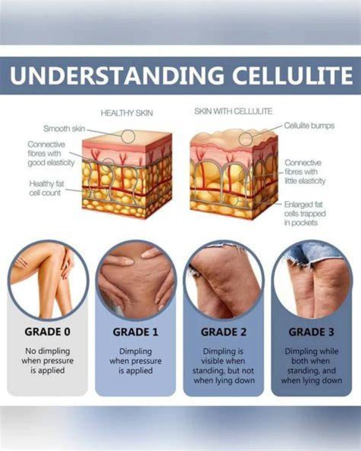 Does ginger get rid of cellulite?