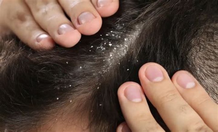 Does hair fall due to dandruff grow back?