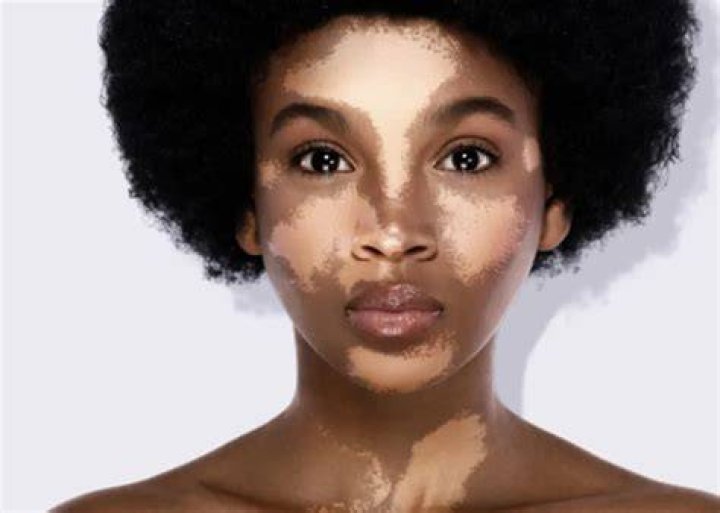 Does vitiligo affect hair growth?