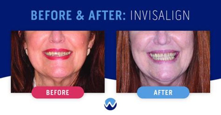 Does your smile change after Invisalign?