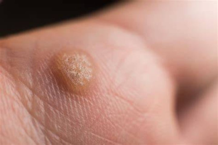 How did I get warts?