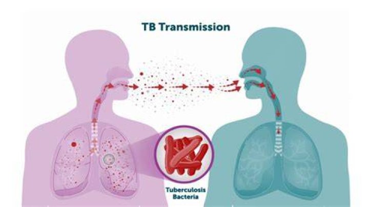 How did TB go away?