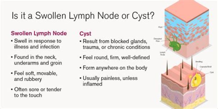How do I know if I have a cyst or a swollen lymph node?