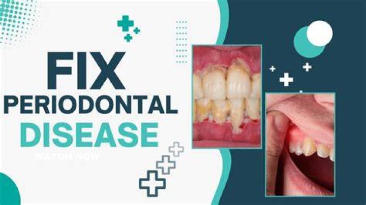 How do you fix severe periodontal disease?