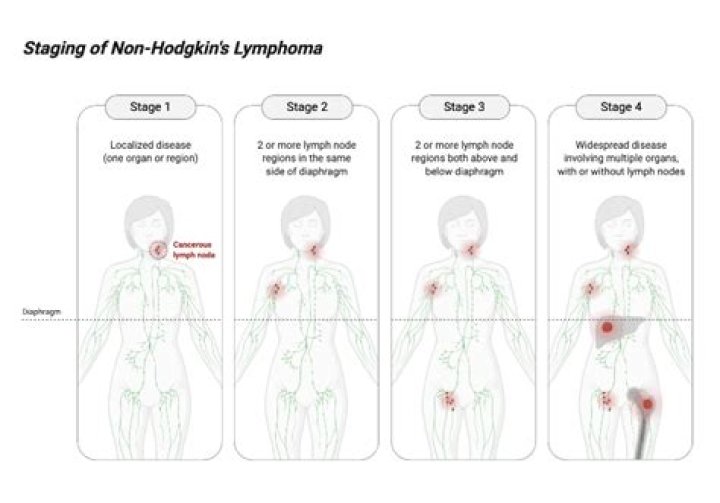 How do you rule out Hodgkin's lymphoma?