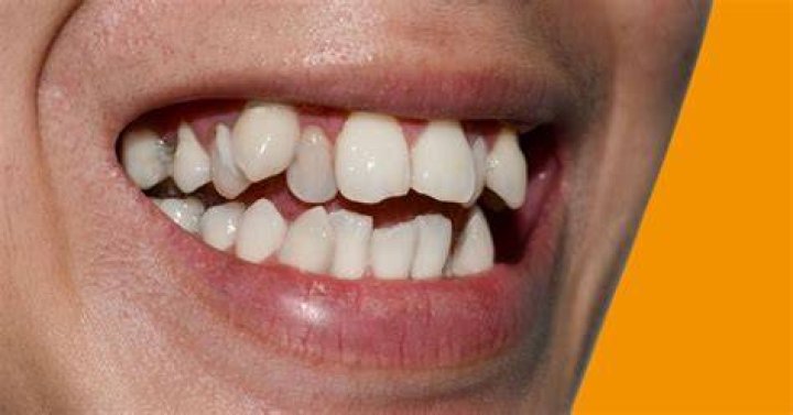 How do you smile with crooked teeth?
