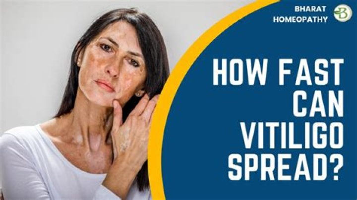 How fast can vitiligo spread?