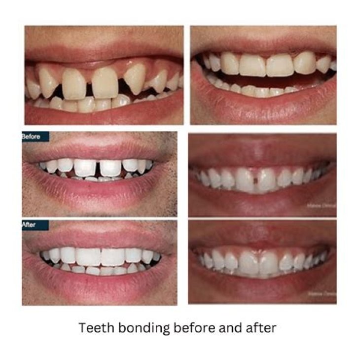 How long after teeth bonding can you eat?