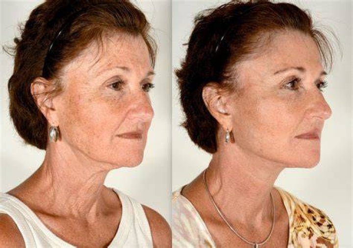 How long does a face lift last?