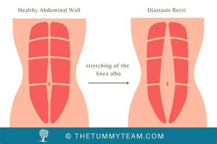How long does it take to fix diastasis recti?
