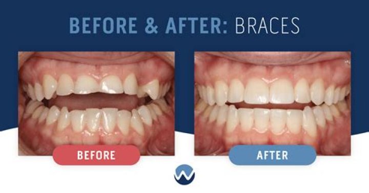 Is 10 too early for braces?