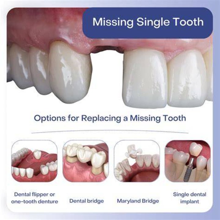 Is it OK not to replace a missing tooth?