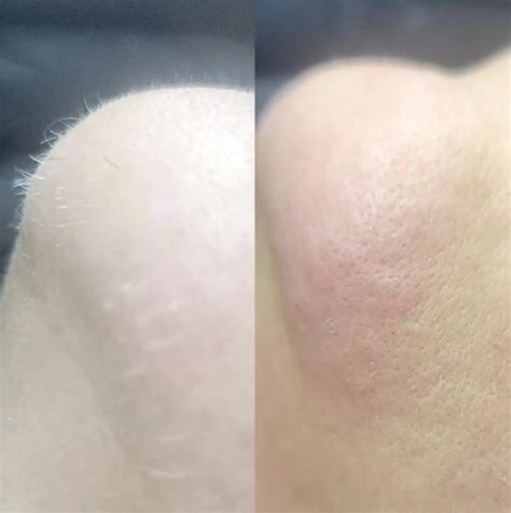 Is laser hair removal cancerous?