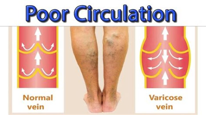 Is there medication for poor circulation?