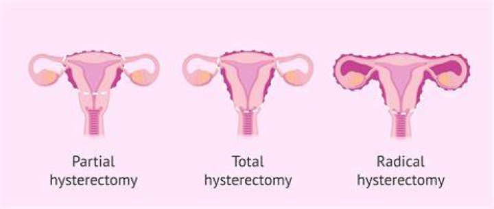 Should I get a hysterectomy if I have precancerous cells?