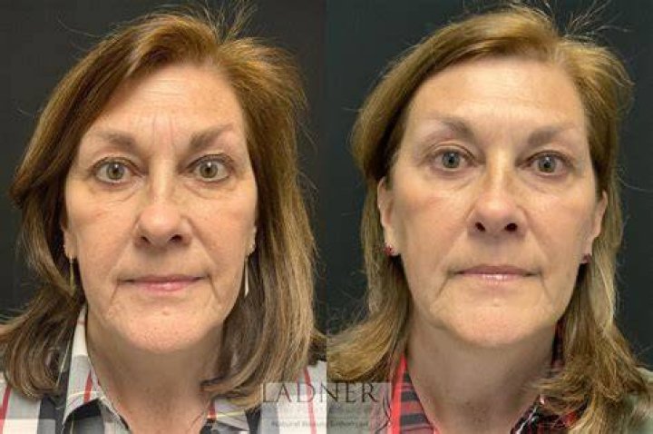 What age is best for fillers?