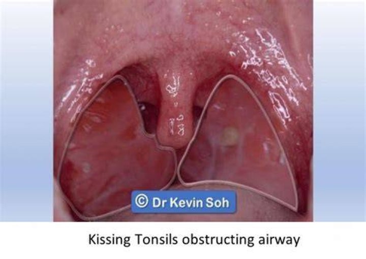 What are kissing tonsils?