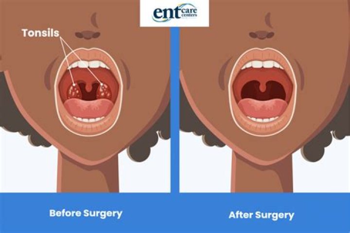 What are the pros of getting your tonsils removed?