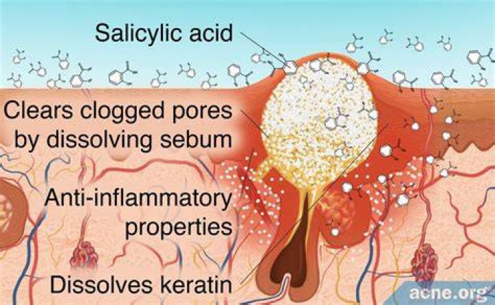 What are the side effects of salicylic acid?