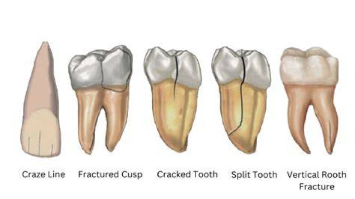What can a cracked tooth lead to?