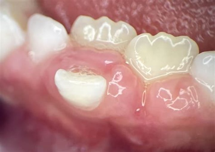 What causes double teeth?