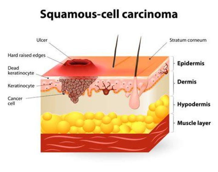 What causes squamous cell carcinoma of the cervix?