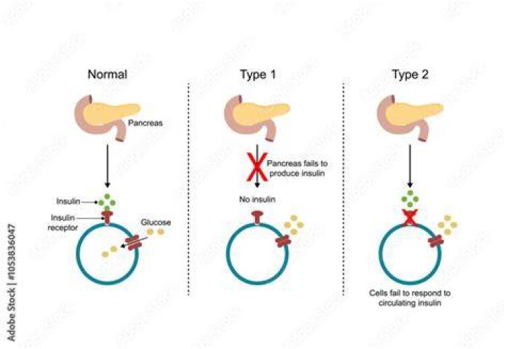 What causes the pancreas to stop producing insulin?