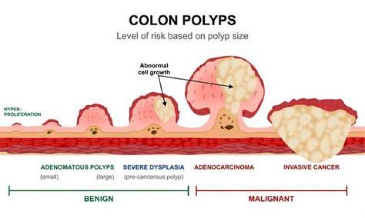 What Colour is a cancerous polyp?