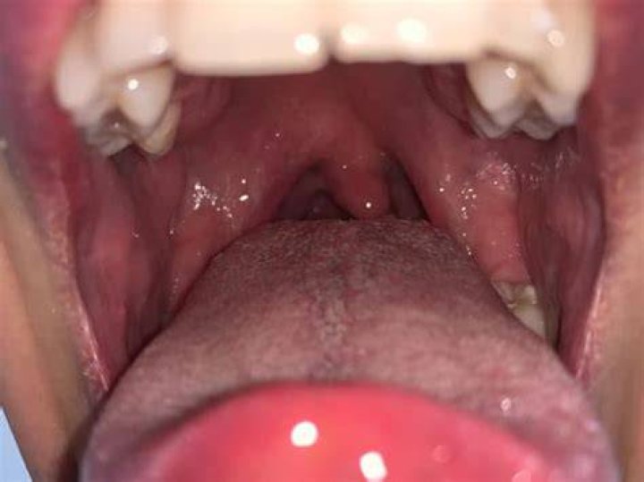 What do infected tonsils look like?