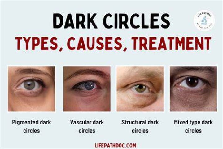 What do models use for dark circles?